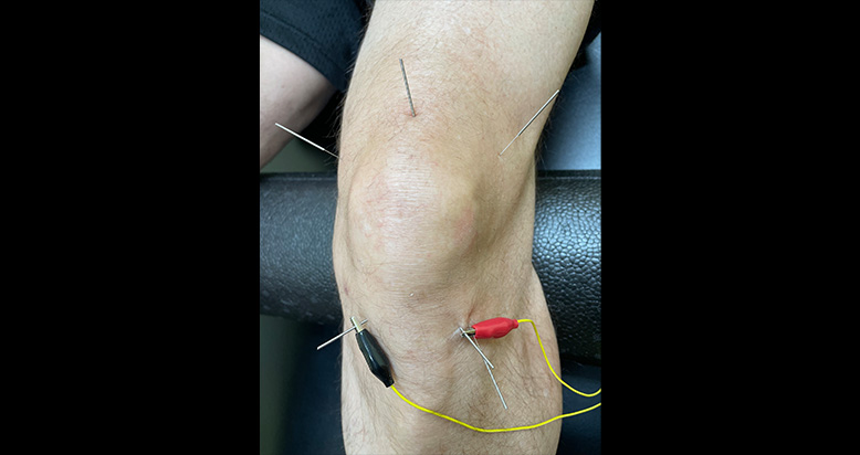 Dry needling for knee pain