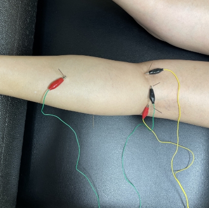 What is Electro-Dry Needling and how can it help with chronic pain and  injury treatment?