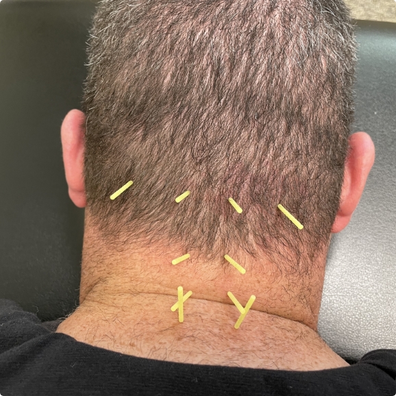 Dry Needling